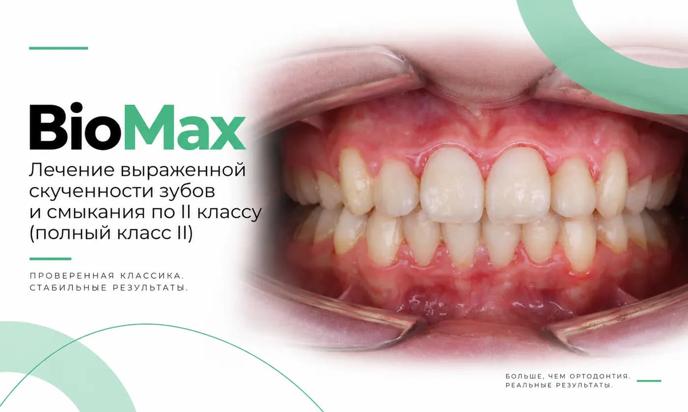 BioMax: выраженная скученность и смыкание по II классу