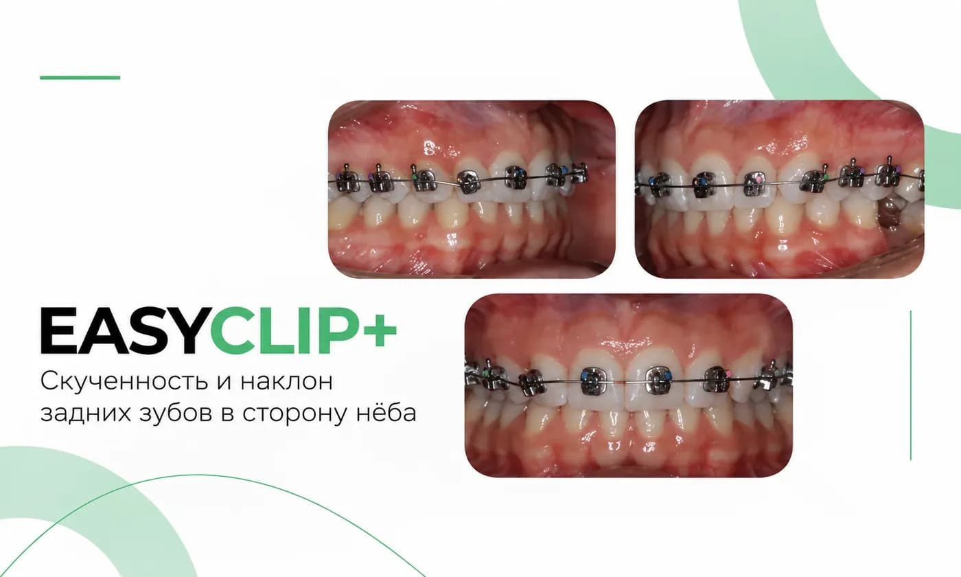 EasyClip+: скученность и нёбный наклон боковых зубов